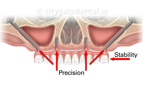 zygomatic3